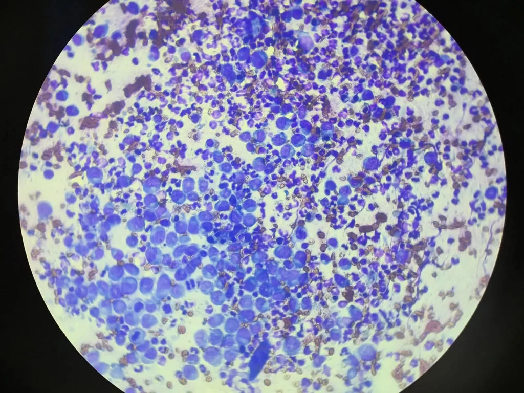 cutaneous plasmacytoma